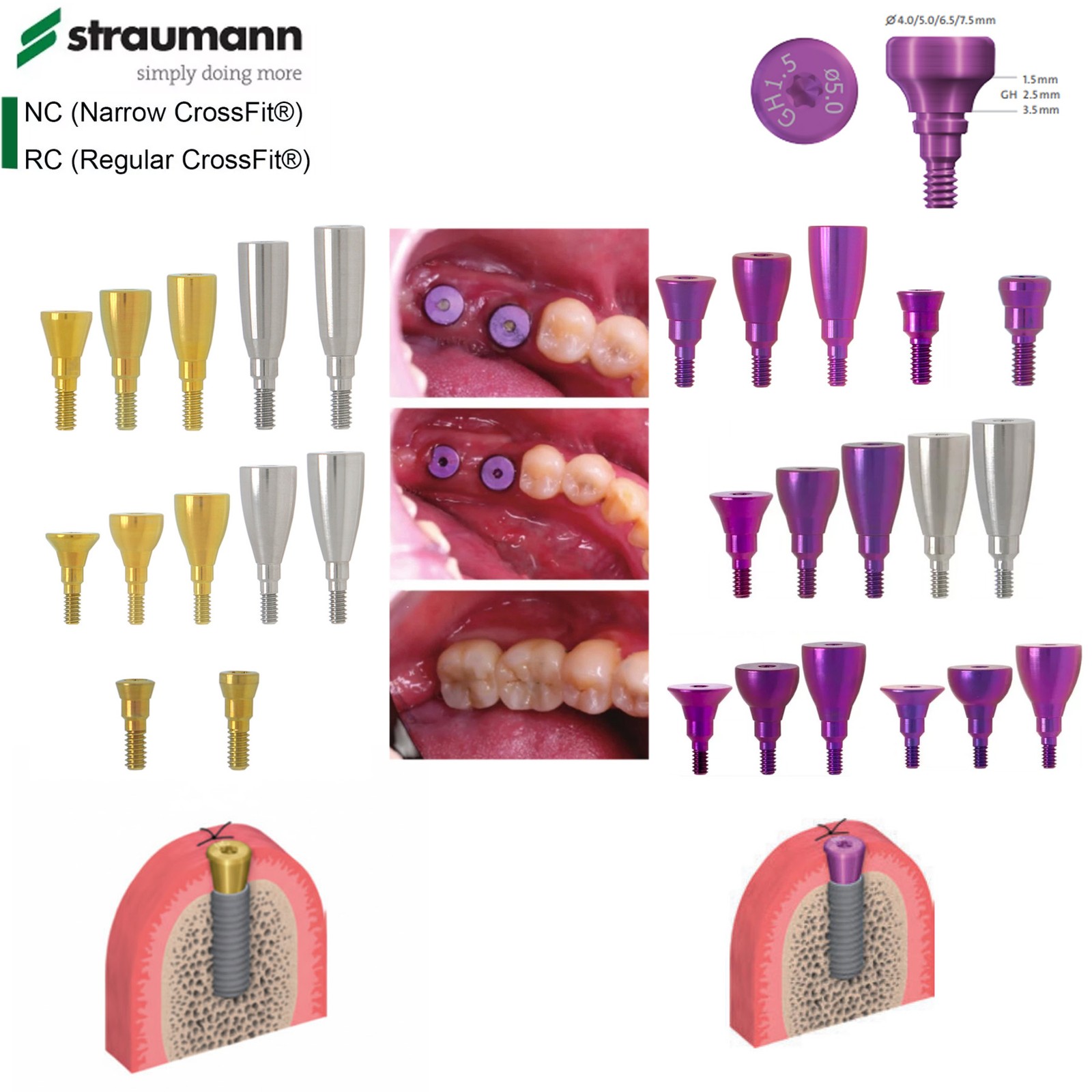US Implant Accessories Healing Closure Abutment Fit Straumann ITI Dental Clinic