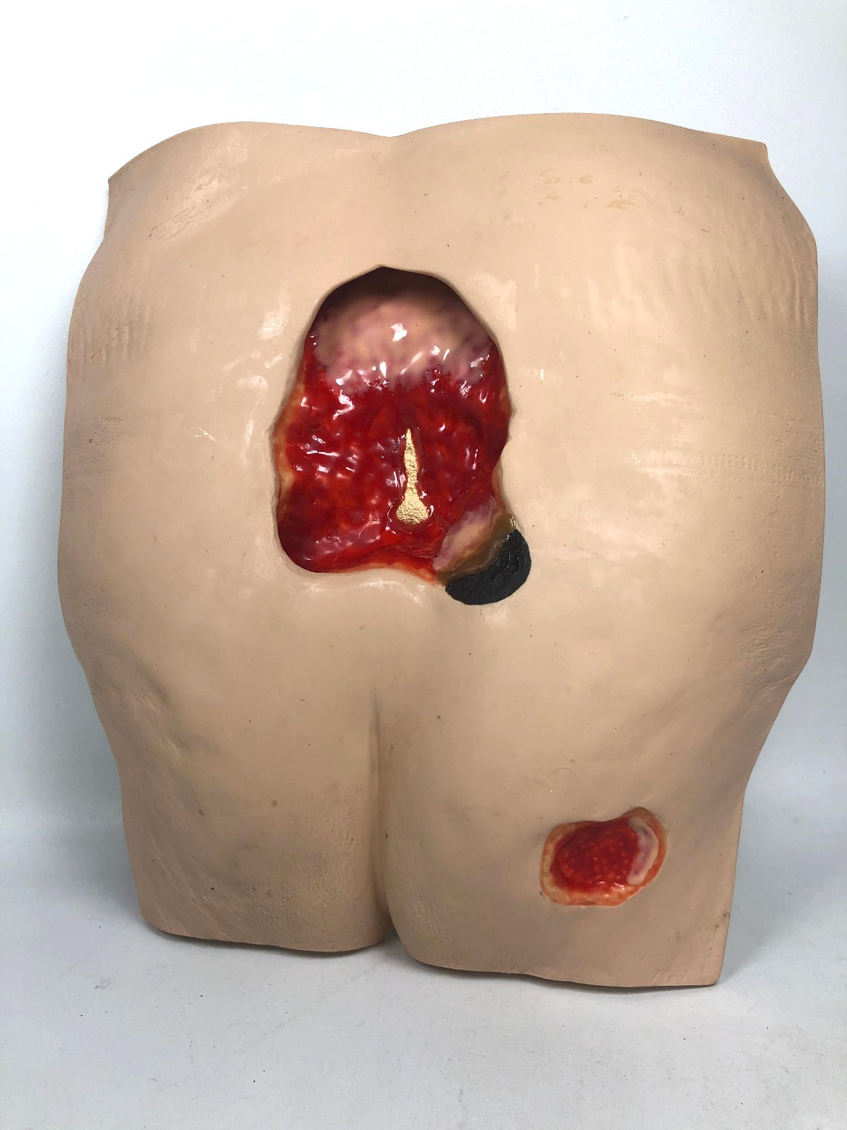 VATA ‘Stan’ Stage IV Pressure Ulcer Model 0970 with Carry Case