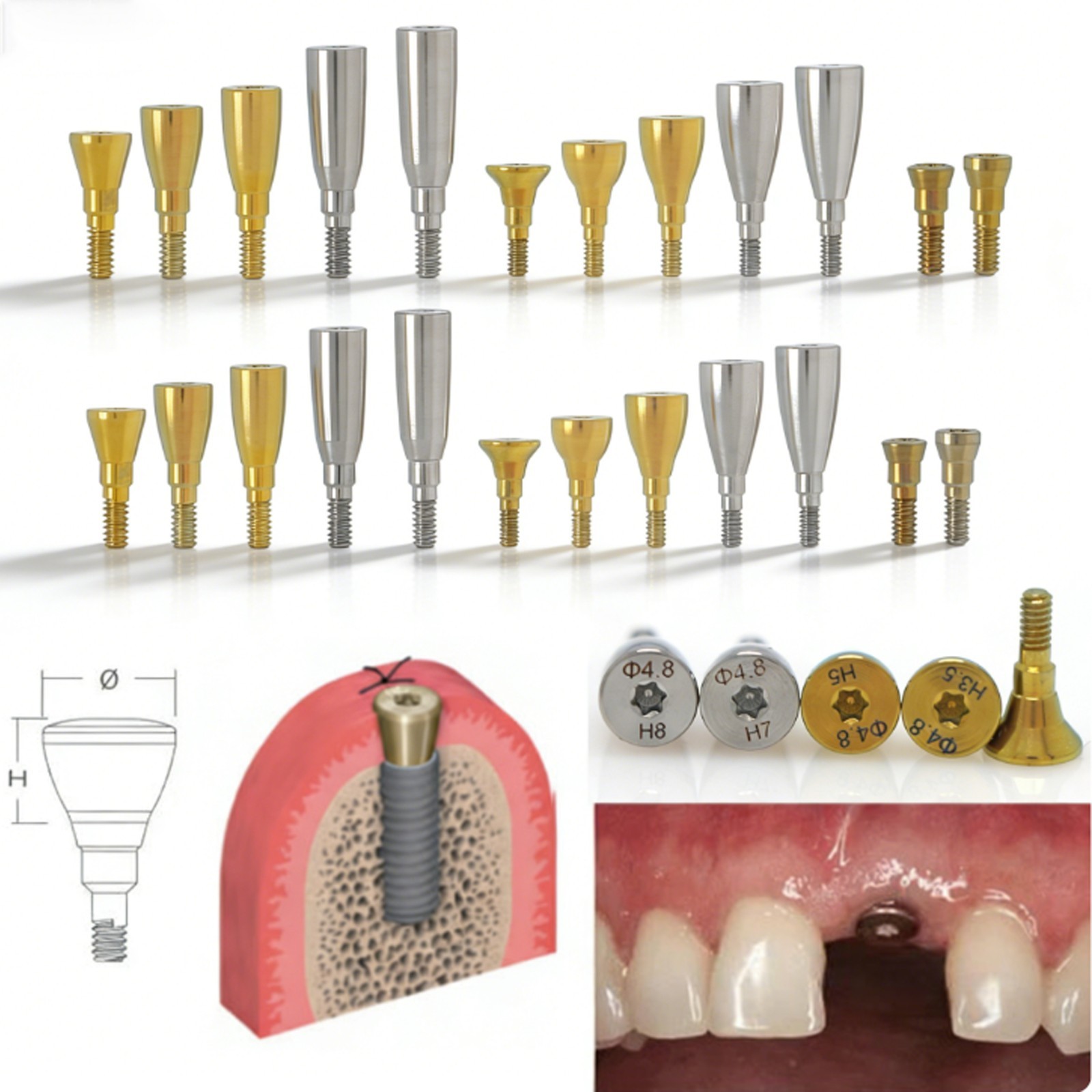 NC Titanium Healing Abutment & Closure Cap Fit Straumann ITI BLT Narrow CrossFit