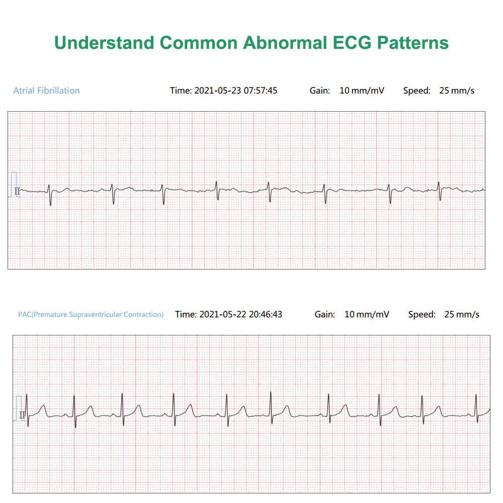 AI Analysis EKG Monitor Heart Monitor 30s/60s/5min Recording with App PC Report