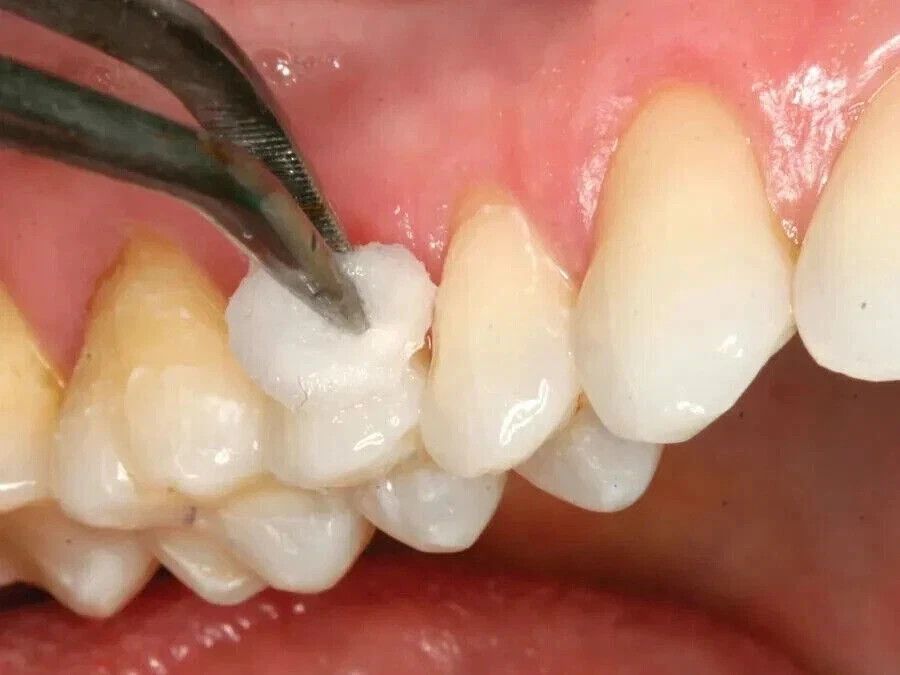 Denpro Cavity Varnish with Flouride 15gm For Dental Use (FREE & FAST SHIPPING).